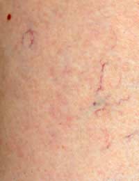 Varicose Veins Abnormal Leg Veins Blood