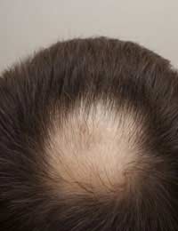 Baldness Hair Loss Hair Loss Treatment